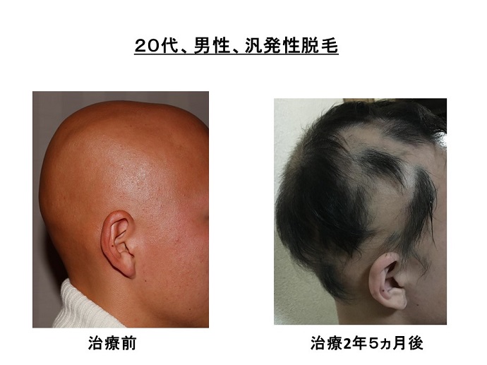 円形脱毛症　病院
